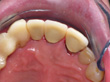 Dr. Schoonover -- Bone Graft, Mini Implant and Crown (After)