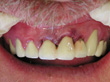 Dr. Schoonover -- Bone Graft, Mini Implant and Crown (After)