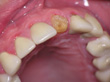 Dr. Schoonover -- Bone Graft, Mini Implant and Crown (Before)