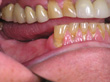 Dr. Schoonover -- Mini-Implant Crowns (Before)