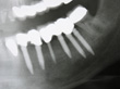Dr. Schoonover -- Mini-Implant Crowns (X-Ray)
