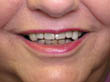 Dr. Schoonover -- Mini Implant Dentures
