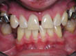 Dr. Schoonover -- Implant Crowns (Before)
