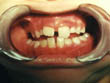 Dr. Schoonover -- Orthodontics (Before)