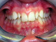 Dr. Schoonover -- Orthodontics (Before)
